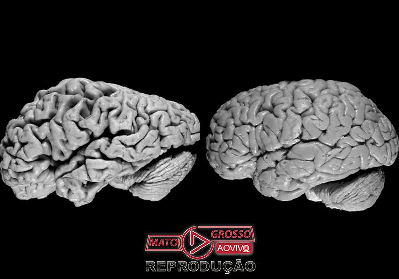 Cérebro com (esq) e sem Alzheimer - Foto: Universidade da Califórnia